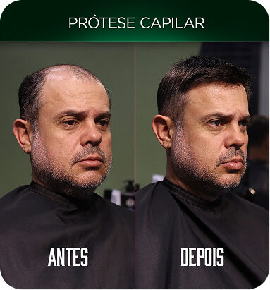 Case de prótese capilar
